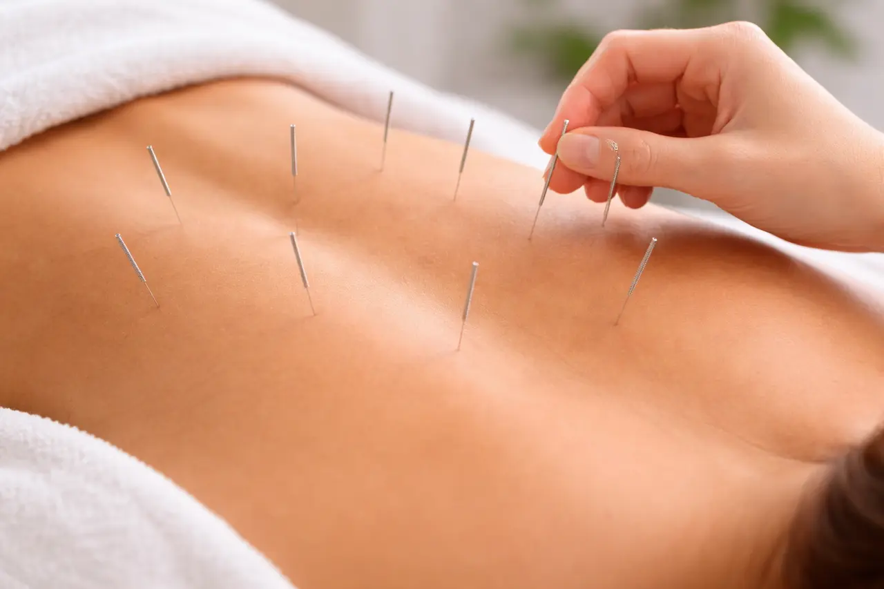 Acupuntura